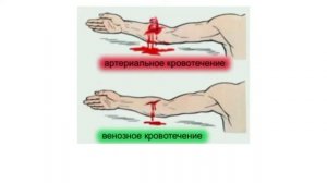 Остановка артериального кровотечения