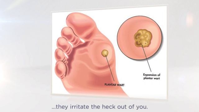 Wart Removal Treatments