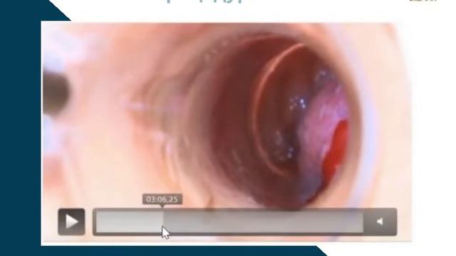 Радиочастотная абляция: проведение процедуры смотреть онлайн