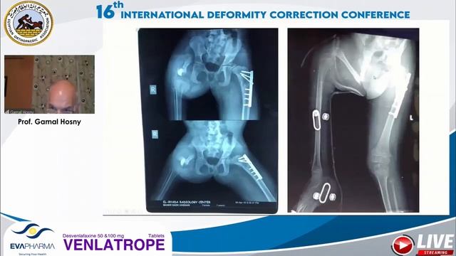 Congenital short femur (Prof. Gamal Hosny) смотреть онлайн