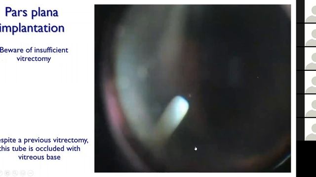 2020 04 30 Chilean webinar the truth about tubes смотреть онлайн
