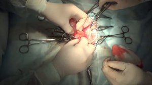 Хирургическое лечение новообразования влагалища