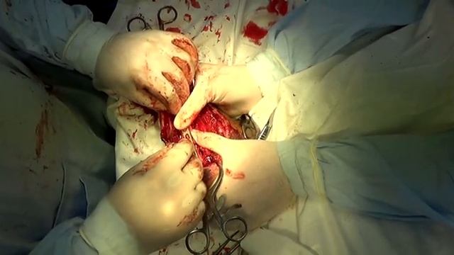 Остеосинтез голени, LCP-пластина