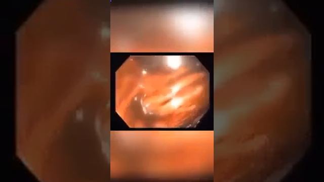 Лечение запоров, кишечника, здоровье, иммунитет #greenmax #кишечник #запор #чистка