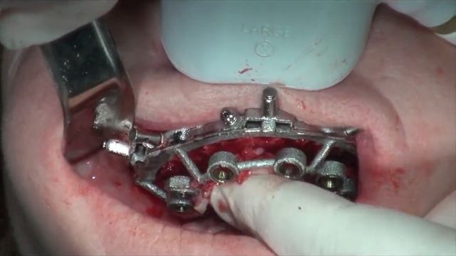 CHROME GuidedSMILE Surgery - Dr. Brent Boyse Express Speed смотреть онлайн
