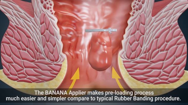[ENDOVISION CONSUMABLE] Hemorrhoid Ligation Clip, BANANA CLIP смотреть онлайн