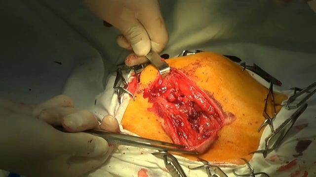 Резекционная артропластика ТБС