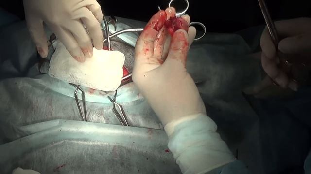 Резекционная артропластика ТБС