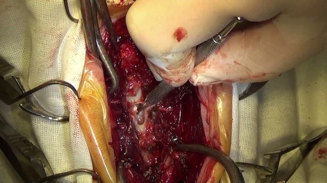 Вентральный пропил. ГМПД шейного отдела