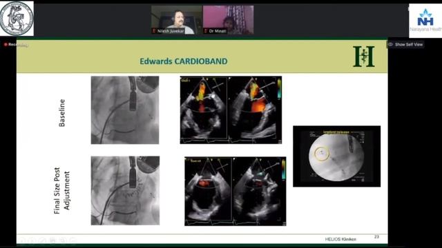 Dr. Chirojit Mukherjee: Beating heart mitral valve surgery -Echo perspectives смотреть онлайн