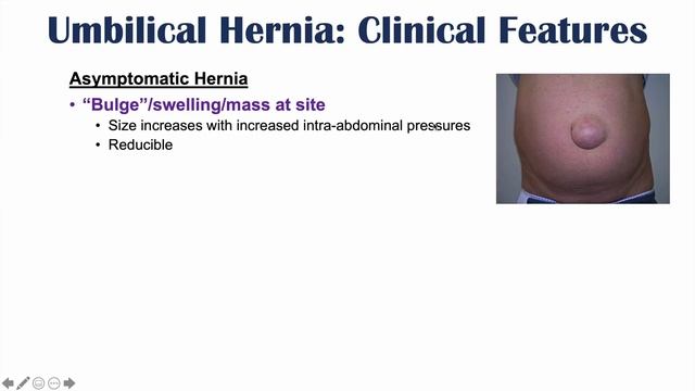 Umbilical Hernia | Belly Button Hernia | Risk Factors, Signs and Symptoms, Diagnosis, Treatment смотреть онлайн