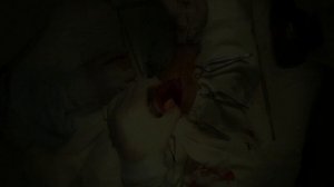 Хирургическое лечение медиальной нестабильности плечевого сустава
