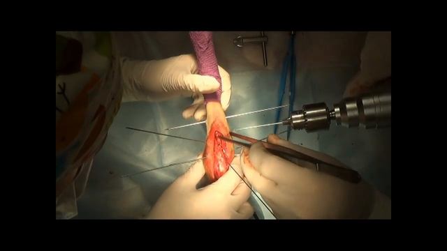 Проксимальный эпифизиолиз большеберцовой кости