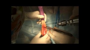 Проксимальный эпифизиолиз большеберцовой кости