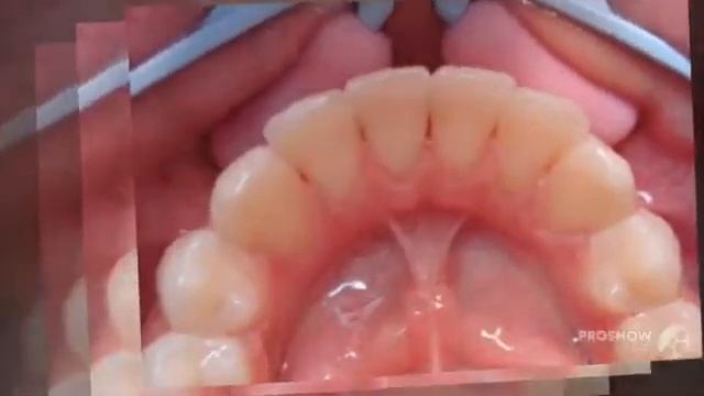 домашнее отбеливание зубов смотреть онлайн