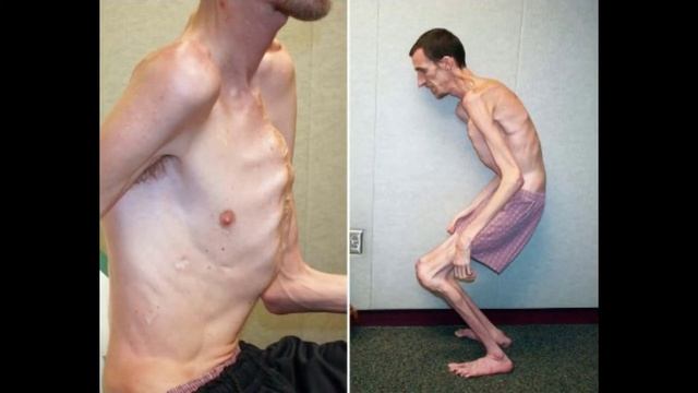 This Is Marfan Syndrome