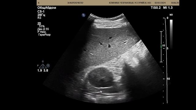 Нефролитиаз , кисты почек смотреть онлайн