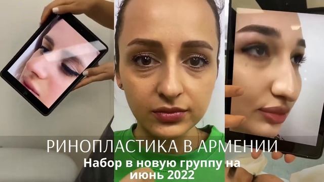 Ринопластика в Ереване смотреть онлайн