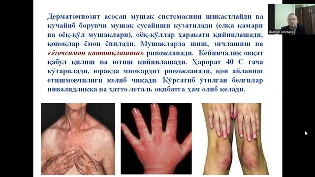 Дерматомиозит смотреть онлайн