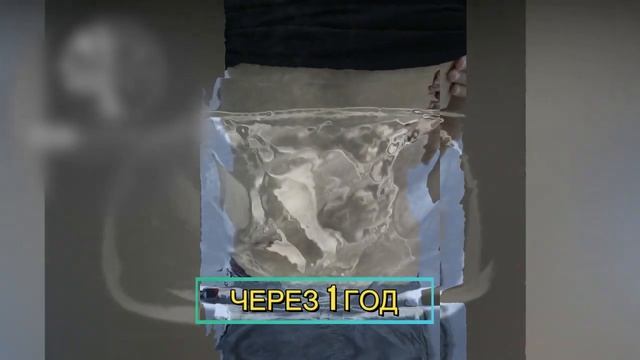 Результат лечения лимфатической мальформации (лимфангиомы)