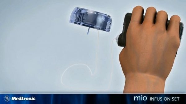 Medtronic Mio Infusion Set - How to Guide