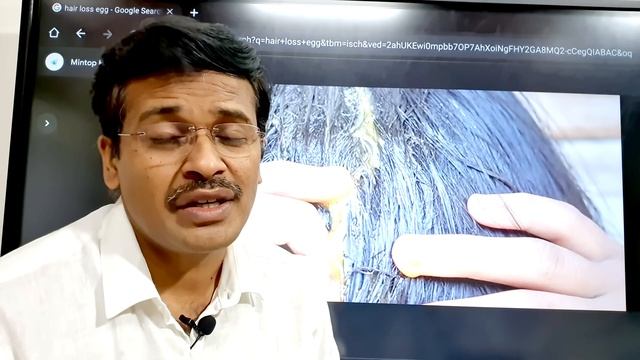 Foods to prevent hair fall and hair loss in tamil | Tips by Doctor karthikeyan смотреть онлайн