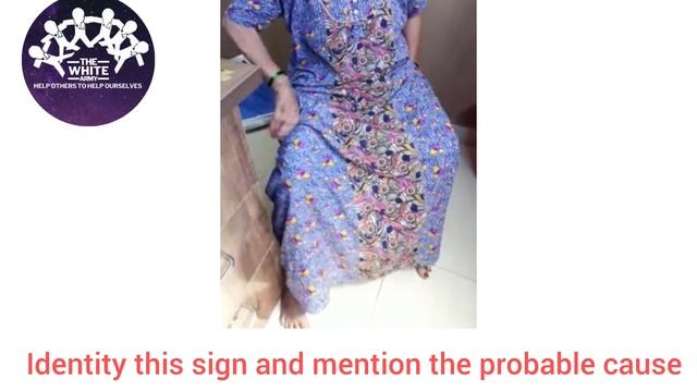 Identity this sign and mention the probable cause | Clinical Signs | Neurology смотреть онлайн