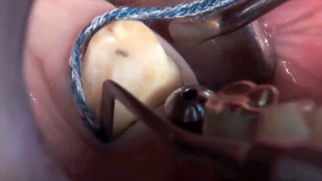Toma de impresión de implante y muñón en un paso con dos consistencias y portaimpresiones plástico смотреть онлайн