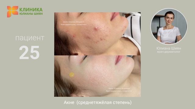 25. Акне среднетяжёлая степень (до и после) смотреть онлайн