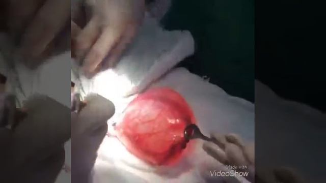 OVARIAN cyst- Киста яичника смотреть онлайн