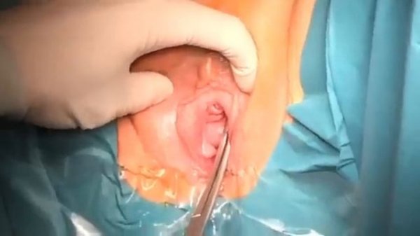 Test for latent stress incontinence