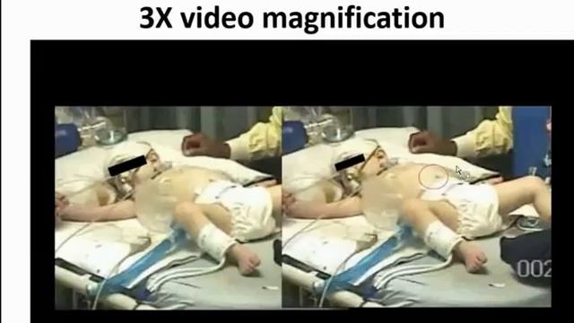 George Peterson, M.D., Ph.D. - SUDEP: Neither Sudden nor Unexpected смотреть онлайн