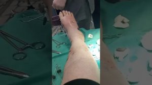 Снятие аппарата Илизарова