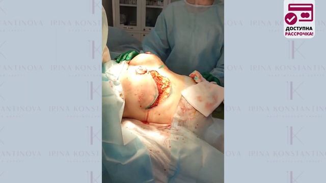 Редукционная маммопластика L-рубец. Пластический хирург Константинова И.В. смотреть онлайн
