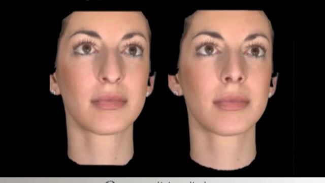 Rhinoplasty 3D simulation www.exelixismedical.gr .wmv смотреть онлайн