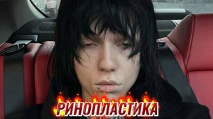 Ринопластика