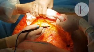 Мужская абдоминопластика.  Константинова Ирина Валерьевна