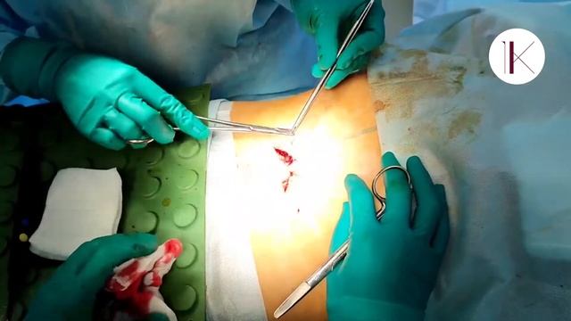 Пластика пупка. Съемка с операционного стола. Пластический хирург Константинова И.В. смотреть онлайн