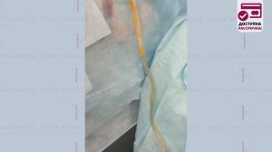 Липосакция "вдовьего горбика" или холки. Хирург Константинова И.В.