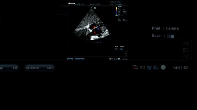 Дефект межпредсердной перегородки. ООО