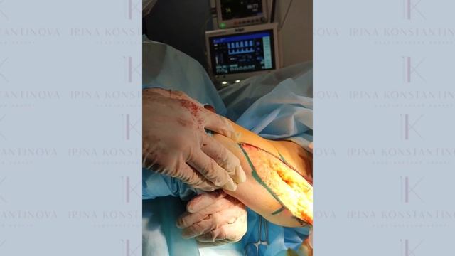 Брахиопластика - пластика рук. Хирург Константинова И.В. смотреть онлайн