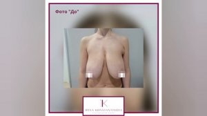 Редукционная маммопластика - как выглядит грудь после уменьшения с операционного стола?