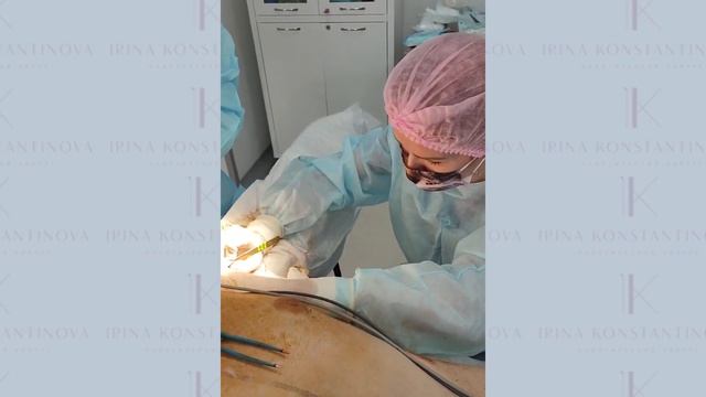 Брахиопластика - пластика рук. Как проводится пластическая операция? смотреть онлайн