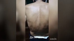 Лечение болезни БЕХТЕРЕВА! Очень просто!