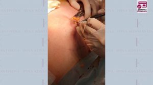 Удаление гинекомастии: съемка с операционного стола - хирург Константинова Ирина