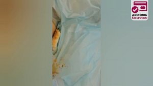 Удаление истинной гинекомастии у мужчины. Проведение операции и результат в конце видео