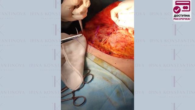 Как проходит абдоминопластика - пластика живота. Сьемка с операционного стола смотреть онлайн