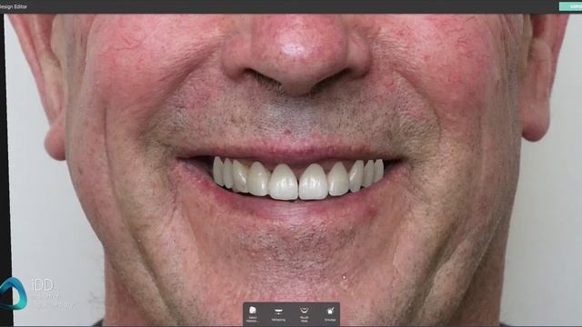 Digital Smile Design Mock-up Demonstration смотреть онлайн