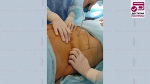 Как проводится липосакция боков? Хирург Константинова И.В.