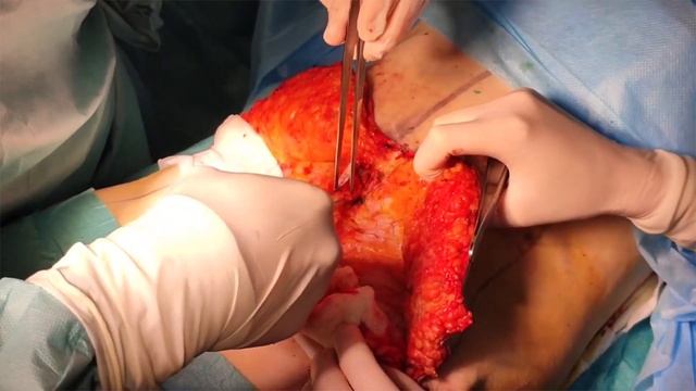 Абдоминопластика - пластика живота. Съемка с операционного стола. смотреть онлайн